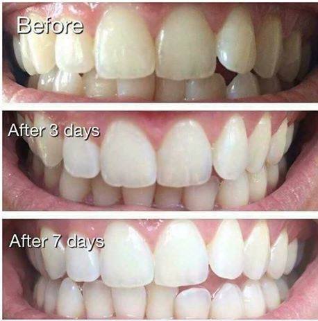 Kem Đánh Răng Làm Sáng Răng Yotuel All in One Intensive Whitening Toothpaste 75ml